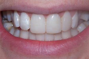 composite-veneers-after