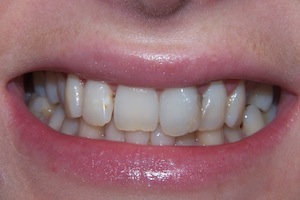 composite-veneers-before