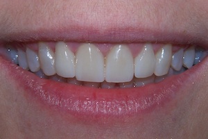 full-smile-porcelain-veneer-after