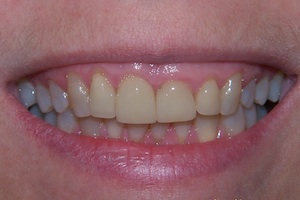 full-smile-porcelain-veneer-before