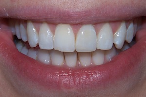 internal-bleaching-after