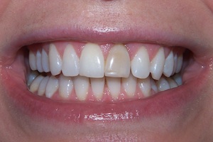 internal-bleaching-before