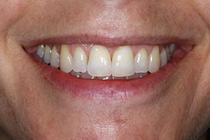 invisalign-after-001