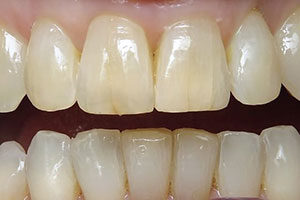 invisalign-after-002