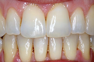 invisalign-after-003