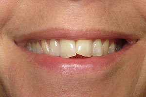 invisalign-before-001