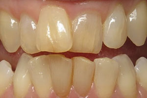 invisalign-before-002