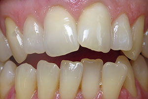 invisalign-before-003