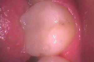 metal-filling-replacement-after