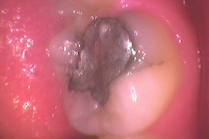 metal-filling-replacement-before