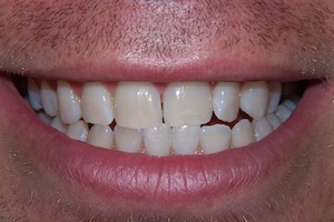 whitening-after