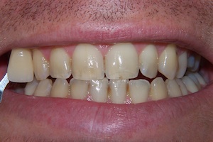 whitening-before